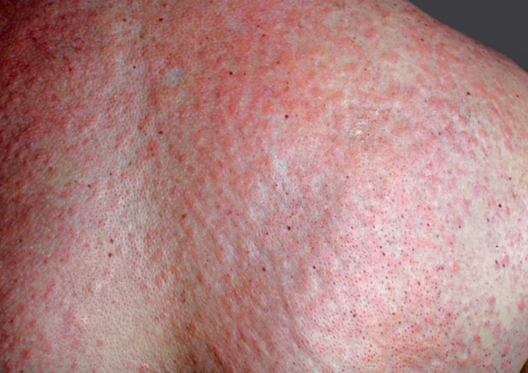 Uczulenie na słońce (fotodermatoza) – przyczyny i jak złagodzić objawy wysypki od słońca
