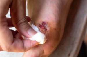 Zakażenie rany – jak rozpoznać? Zapobieganie i leczenie